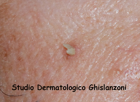 Verruca filiforme viso
