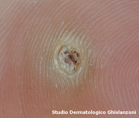 verruca plantare