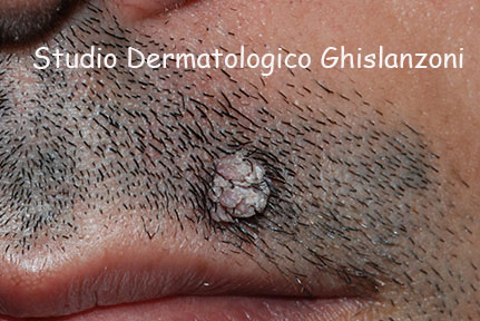 verruca_della_barba.jpg
